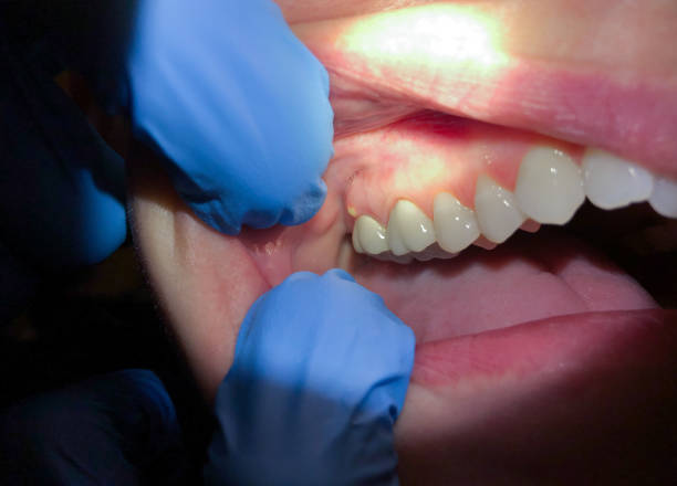 Best Emergency Broken Tooth Repair in Toppenish, WA